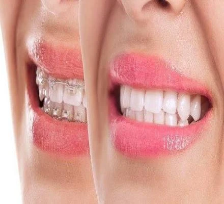 أنواع تقويم الأسنان المختلفة