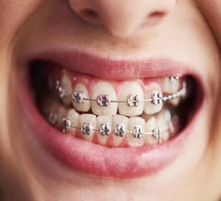 تقويم الأسنان للكبار